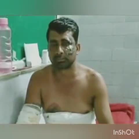 हुज़ूर: गढ़ थाना क्षेत्र में युवक पर कुछ लोगों ने डाला तेजाब, घायल युवक संजय गांधी हॉस्पिटल में भर्ती  #तेजाब