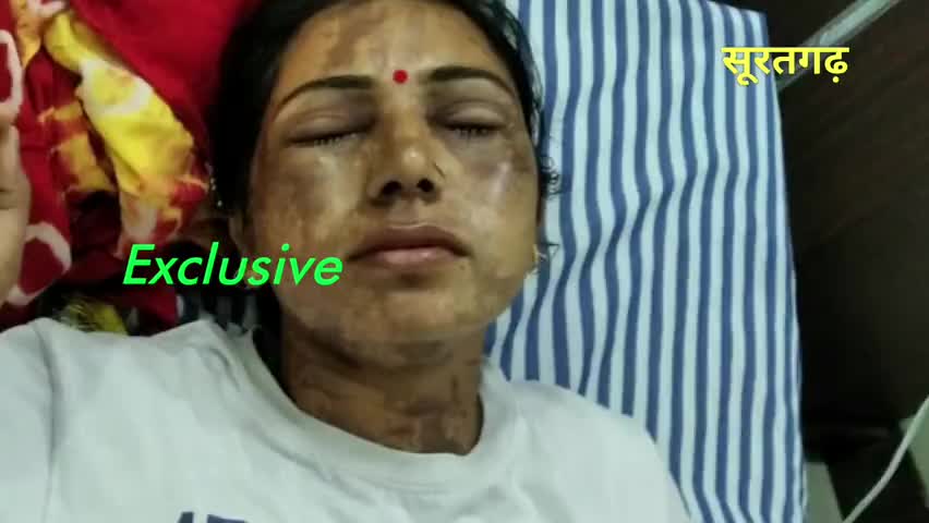 सूरतगढ़: सूर्योदयनगरी स्थित शहरी प्राथमिक स्वास्थ्य केंद्र में हाइपोक्लोराइट सॉल्यूशन तैयार करते समय झुलसी एएनएम #एएनएम