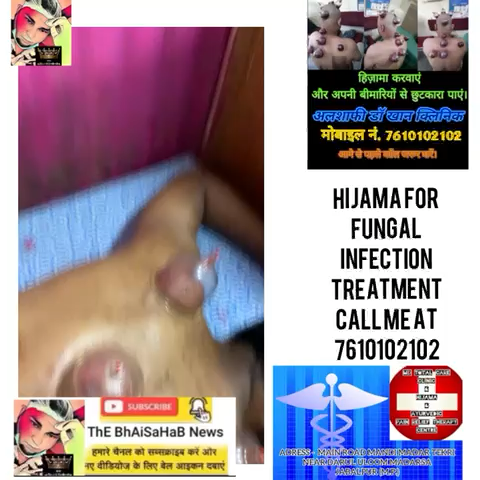 Hijama for back in severe fungal treatment available in jabalpur India
 #hijama #viral