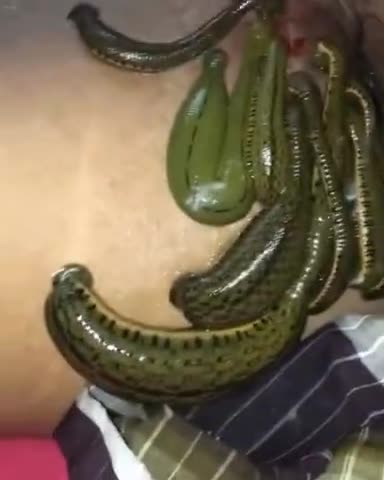 #LEECH_THERAPY जलोकावचरण