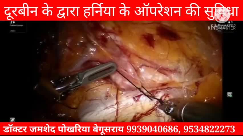 सब से #सस्ता सबसे अच्छा बिना #चिर #फार मैशिन द्वारा #ऑपरेशन डॉ० #जमशेद नवाबचौक, #पोखरिया, #बेगुसराय
कॉल करें- 9534822273