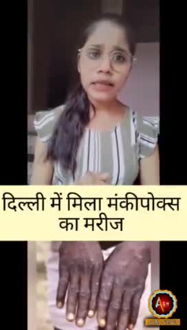 दिल्ली में मंकी पॉक्स तेजी से बड़ रहा है
#monkeypox #delhi
