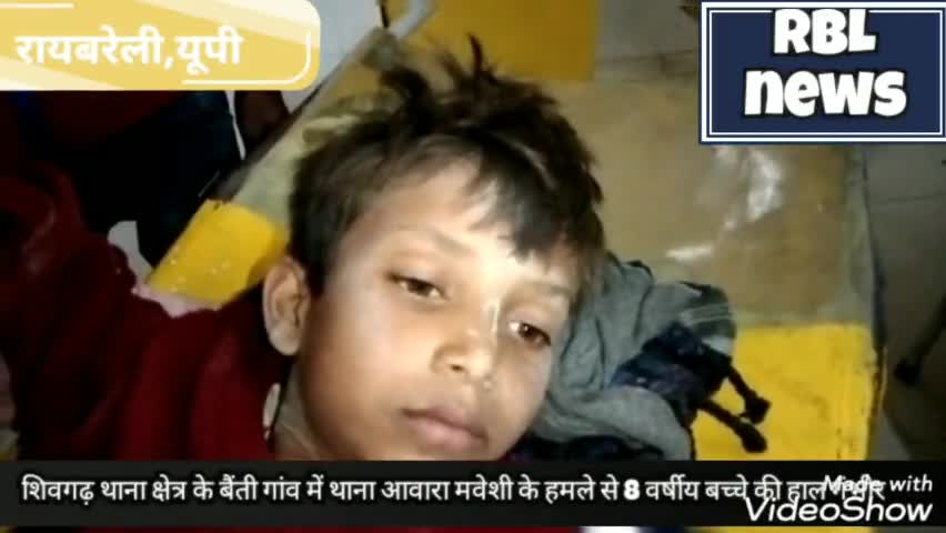 महाराजगंज: #आवारा मवेशी के हमले से मासूम की हालत गंभीर ट्रामा सेंटर लखनऊ रेफर।