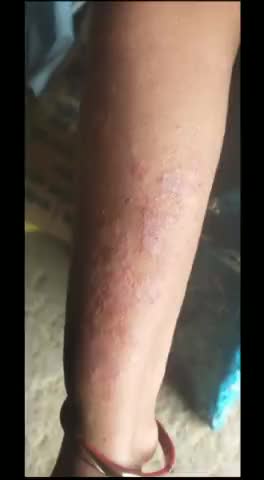 राजस्थान में i-pulse juice का बहुत ही जबरदस्त रिजल्ट। एलर्जी रहती थी। #corona